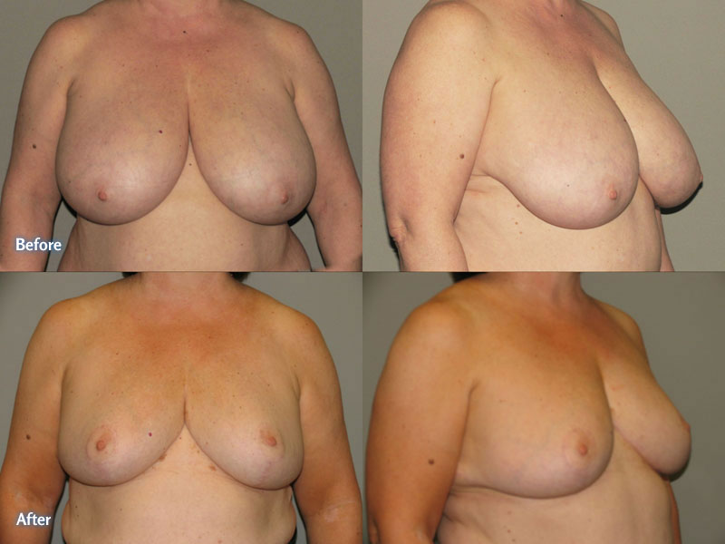 Breast Reduction, Testimonial, Northern Virginia