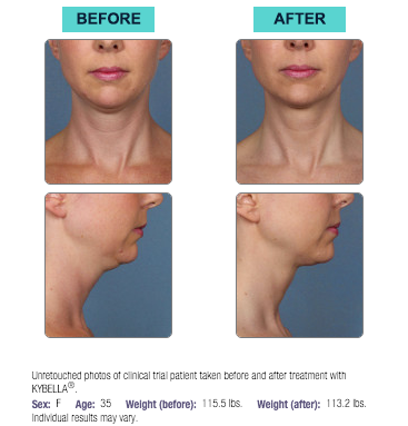 kybella-before-and-after-houston