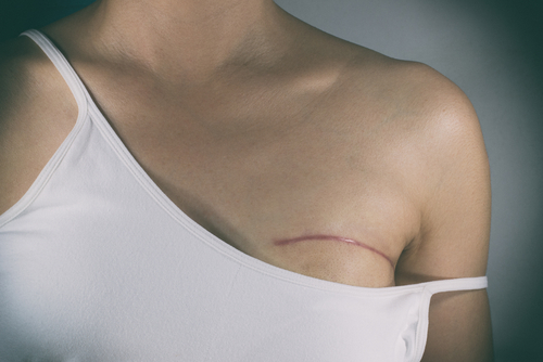 breast-reconstruction